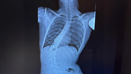 Xray image of spine